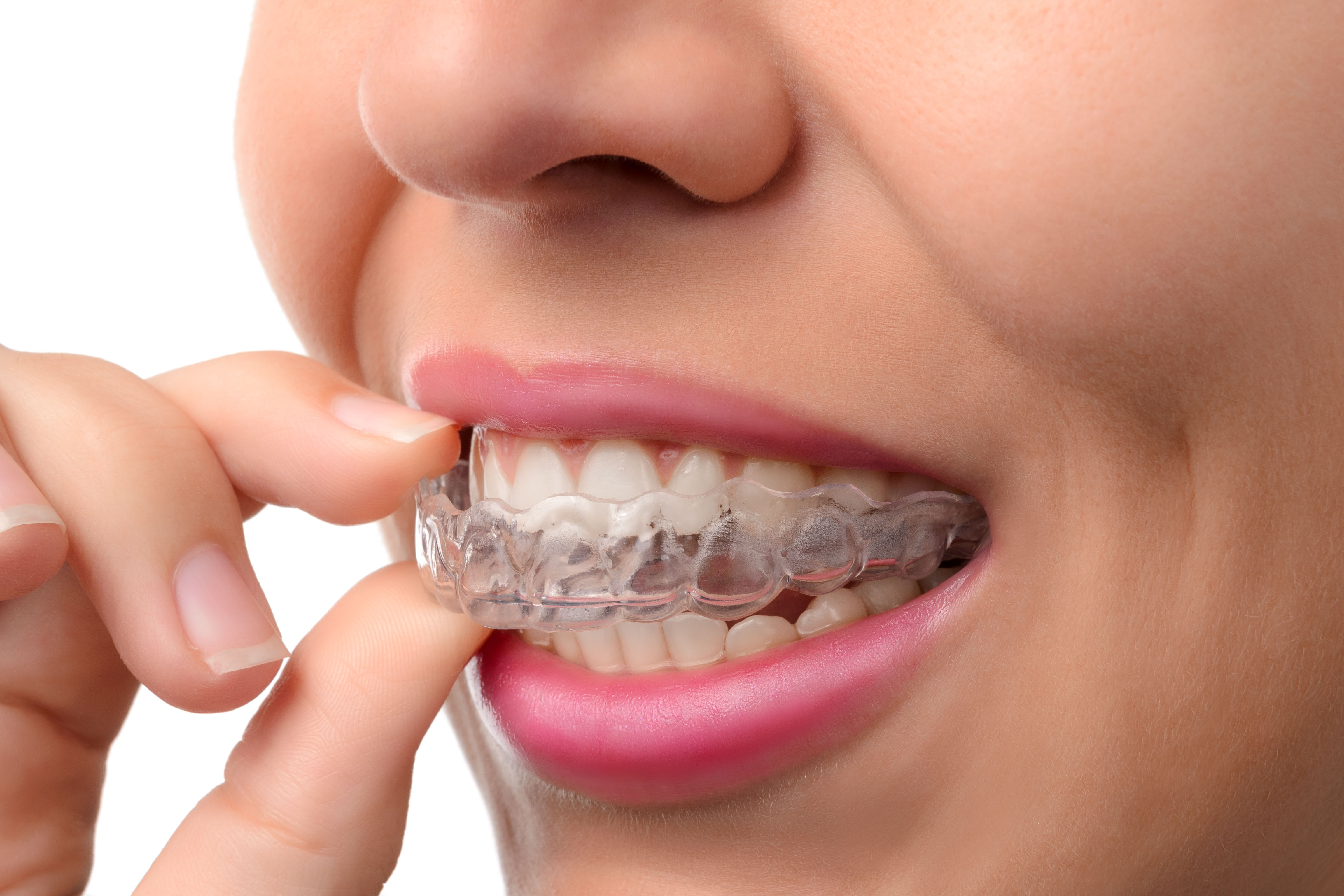 How to Care for Ceramic Braces - Tennison Orthodontics Cleburne, TX