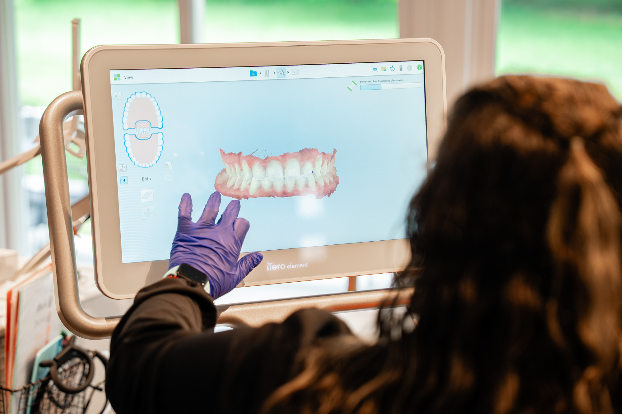 Clear Aligners